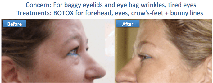 Botox baggy eye bags anti wrinkle tried smooth skin radiant