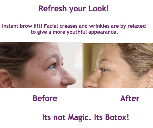It's not Magic. It's Botox