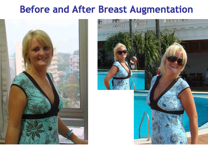 Breast Augmentation SRI LANKA