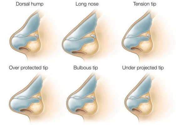 Nose Augmentation Bulbous nose reduction Long nose reduction Short nose extension Hooked nose reshaping Nostrile reduction (alarplasty) Deviated nose correction