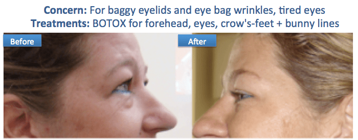 Botox baggy eye bags anti wrinkle tried smooth skin radiant