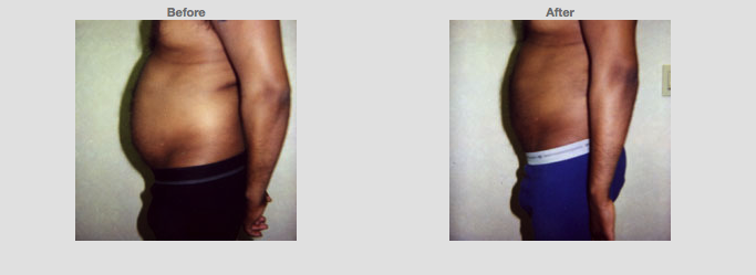 1. Liposuction for abdomen (tummy) 39 years, Male. Side profile. Cosmetic Clinic Colombo. Source: www1.plasticsurgery.org