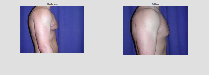 Liposuction Chest. 22 years old. Male. Side profile.Source: www1.plasticsurgery.org