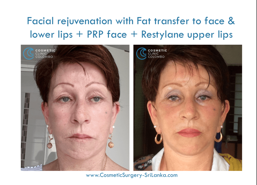 fat graft to face and lips dermal lip filler PRP Cosmetic Surgery Sri Lanka