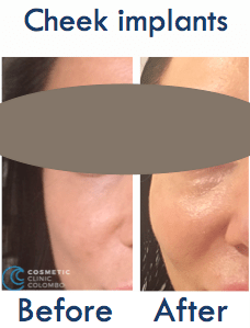 Cheek implants Sri Lanka