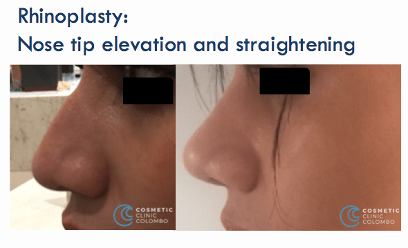 Nose surgery tip elevation and straightening Dr Dulip Sri Lanka