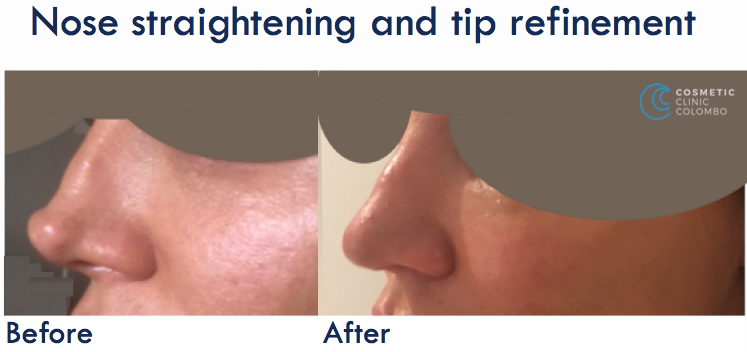Nose Straightening and-tip refinement - Open Rhinoplasty