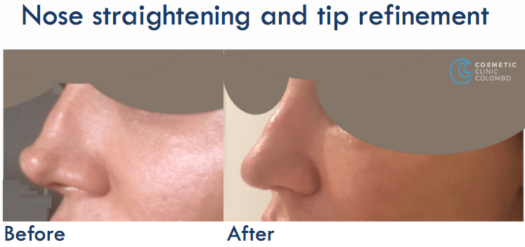 Nose Straightening and-tip refinement - Open Rhinoplasty