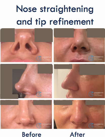 Nose Straightening and Tip Refinement Sri Lanka