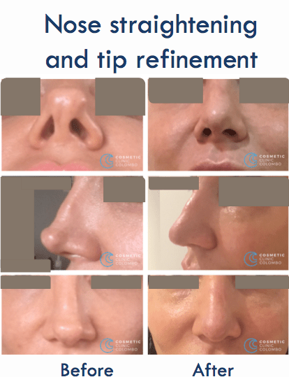Nose Straightening and Tip Refinement Sri Lanka