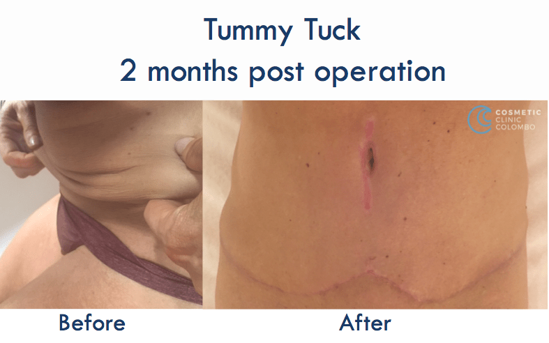 Tummy Tuck Sri Lanka