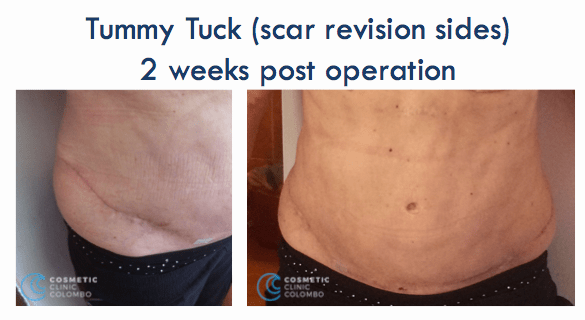 Tummy Tuck Scar liposuction