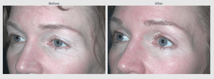 48 years old Female Upper lids only Cosmetic Clinic Colombo, Sri Lanka