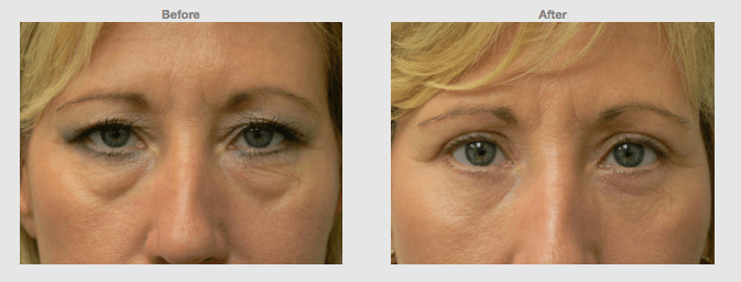 Upper and lower bleph front female Cosmetic Clinic Colombo, Sri Lanka