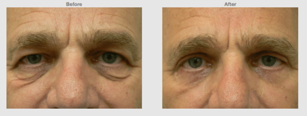 Upper lower eyelids (Eye bags) blephorplasty for men Cosmetic Clinic Colombo, Sri Lanka