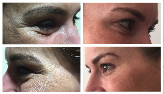 BOTOX for Crows feet, eye bags and hooded eyes and brow lift. Dr Dulip. Dr Thushan