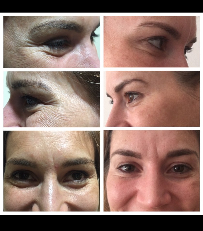 BOTOX for Crows feet, eye bags and hooded eyes and brow lift.