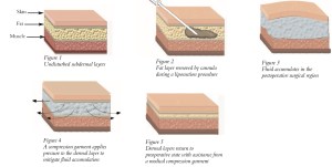 The healing process after liposuction