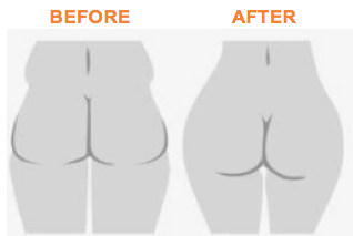 Brazilian Butt Lift Colombo Sri Lanka Dr Dulip Dr Thushan