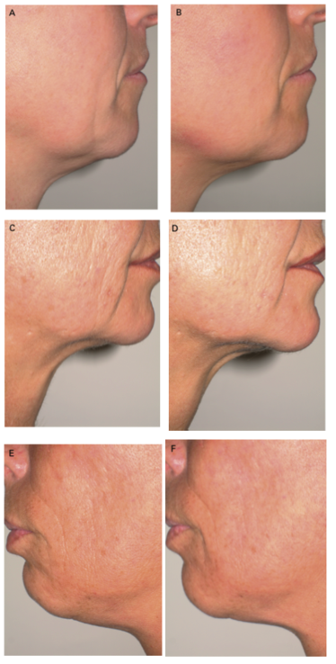 hand, rejuvenation, hydration, elasticity, roughness Skin Boosters HA Filler Colombo Sri Lanka