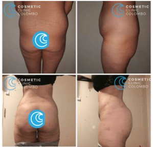 Brazilian Butt Lift Surgery Sri Lanka buttocks Cosmetic surgery