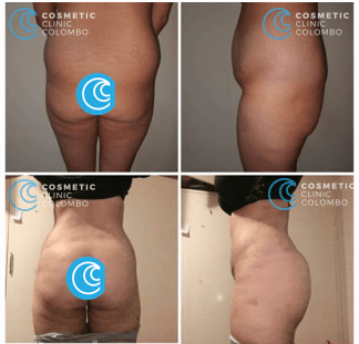 Brazilian Butt Lift Surgery Sri Lanka buttocks Cosmetic surgery