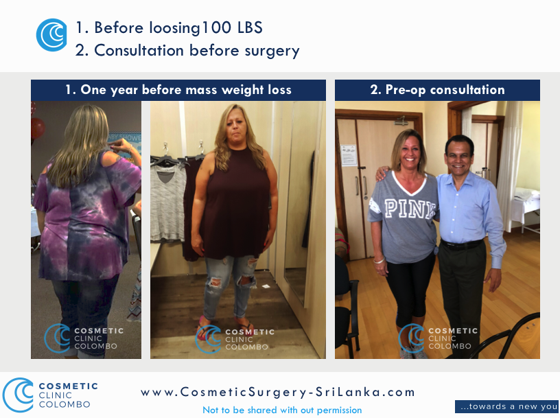 Before Mass Weight Loss 1 year before Cosmetic Surgery Sri LANKA 