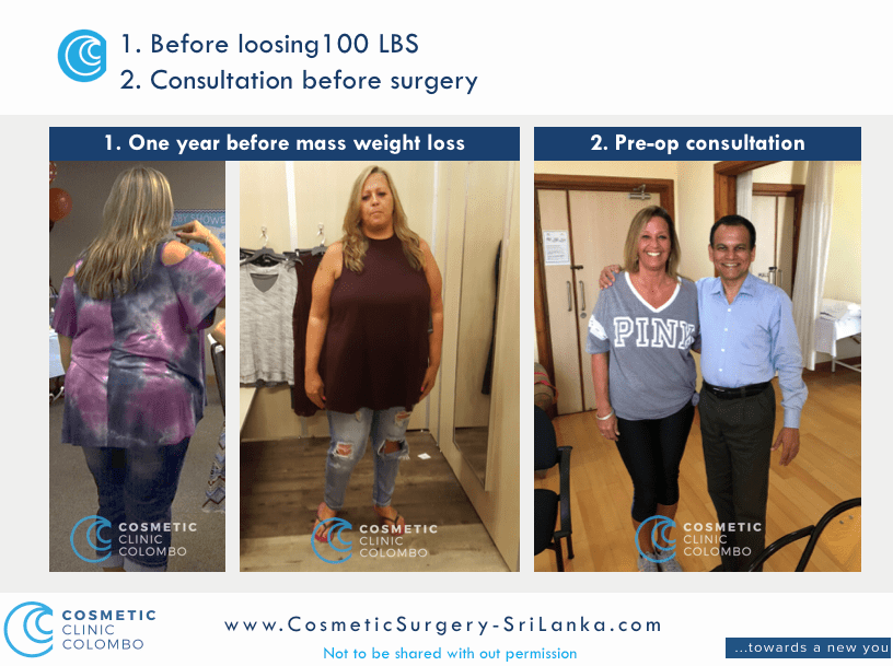 Before Mass Weight Loss 1 year before Cosmetic Surgery Sri LANKA