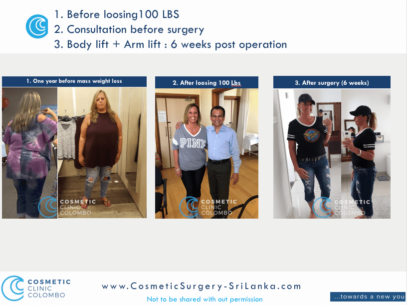 Body Lift and Arm Lift Sri Lanka