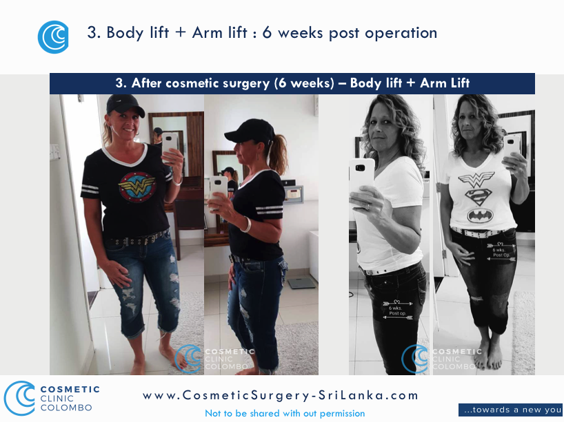 Body Lift and Arm Lift Sri Lanka Post Cosmetic Surgery