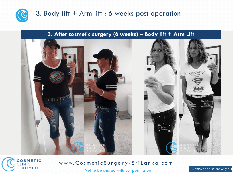 Body Lift and Arm Lift Sri Lanka Post Cosmetic Surgery
