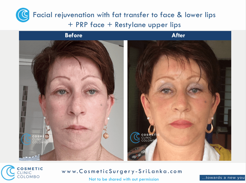 Fat Transfer or fat graft to face and lips dermal lip filler PRP Cosmetic Surgery Sri Lanka
