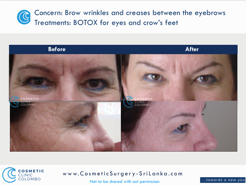 BOTOX for Crows feet, eye bags and hooded eyes and brow lift. Dr Dulip. Dr Thushan