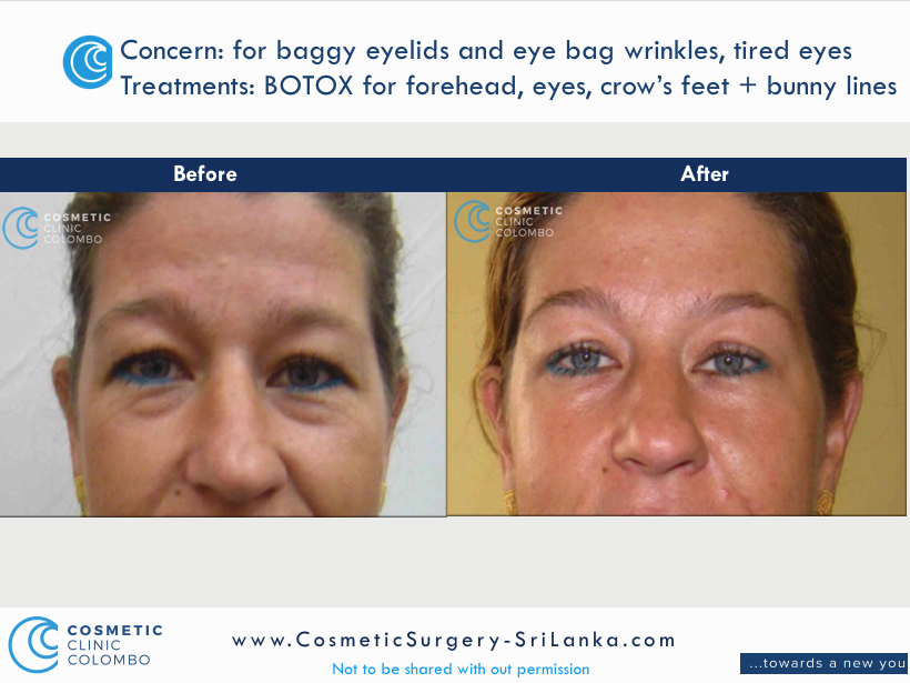 BOTOX for Crows feet, eye bags and hooded eyes and brow lift. Dr Dulip. Dr Thushan
