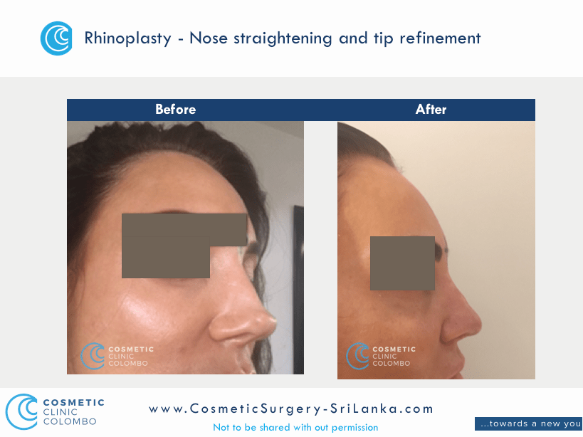 Nose straightening and tip refinement Rhinoplasty Sri Lanka