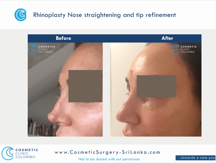 Nose straightening and tip refinement Rhinoplasty Sri Lanka