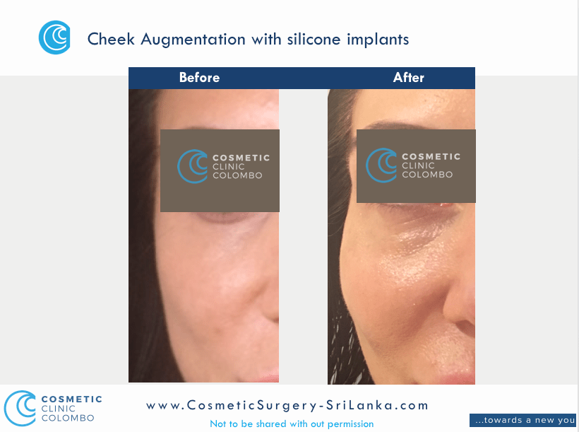 Cheek Augmentation Raised Cheek silicone implants Cosmetic surgery Sri Lanka