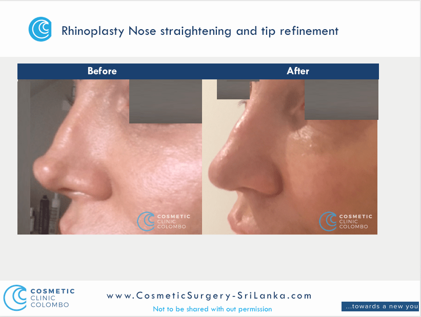 Nose straightening and tip refinement Rhinoplasty Sri Lanka