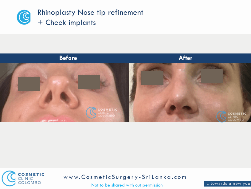 Nose straightening and tip refinement Rhinoplasty Sri Lanka