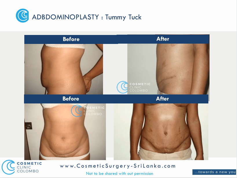 Tummy Tuck Sri Lanka loose skin apron