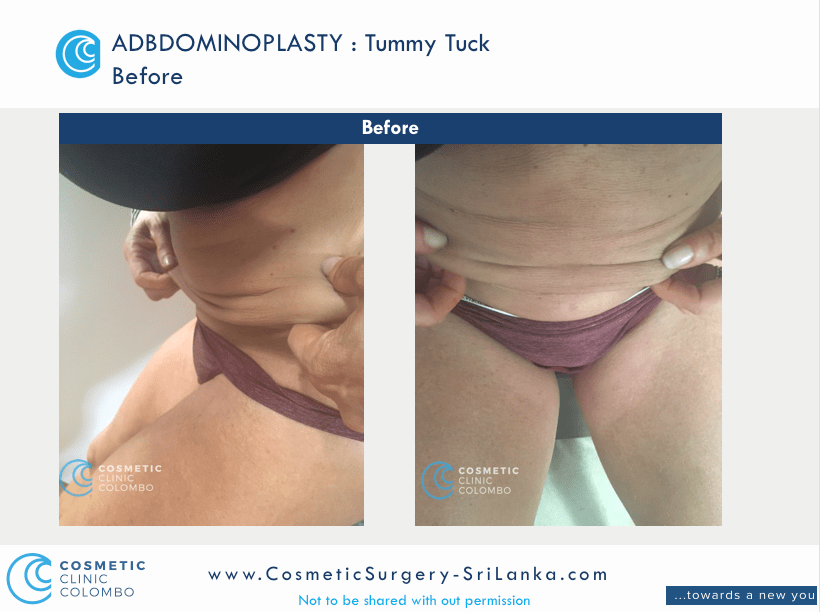 Tummy Tuck Sri Lanka loose skin apron