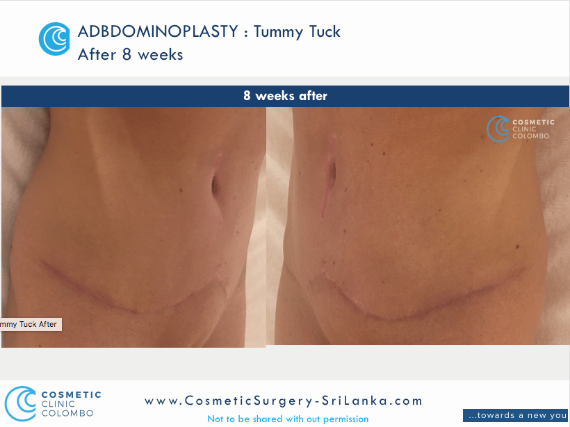 Tummy Tuck Sri Lanka loose skin apron