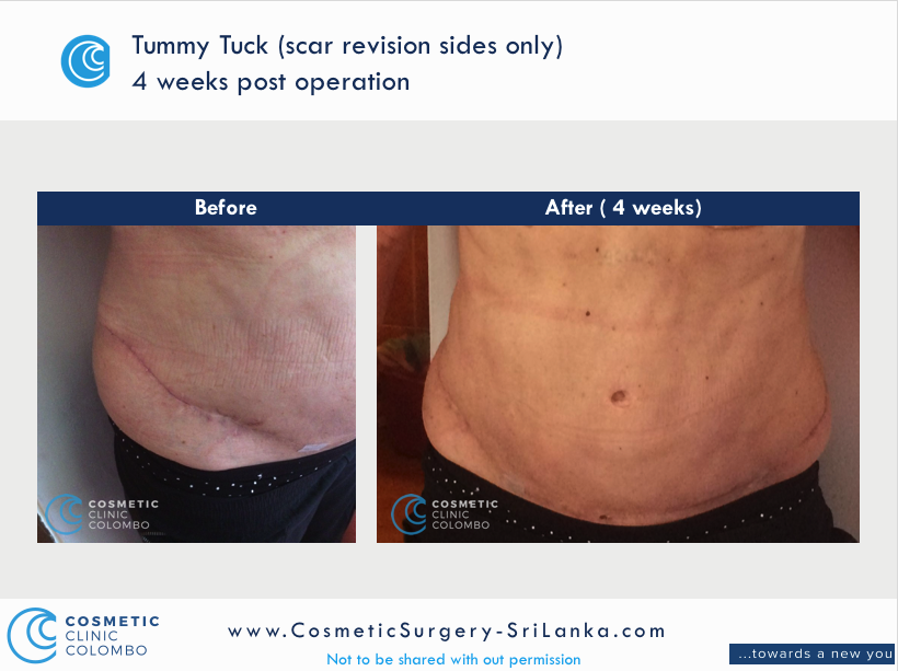 Tummy Tuck Scar Revision to remove uneven ends of the original scar from a previous surgery and additional body contouring with Liposuction waist
