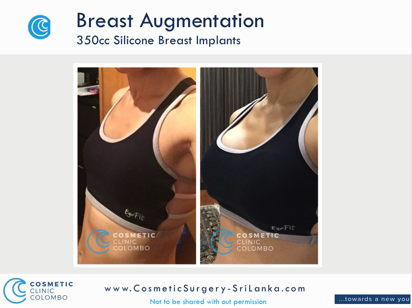 Breast Augmentation Silicone implants Sri Lanka Cosmetic surgery 