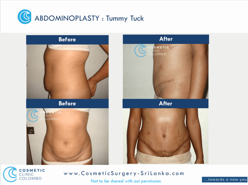 Tummy Tuck Sri Lanka Flat Tummy Apron loose skin