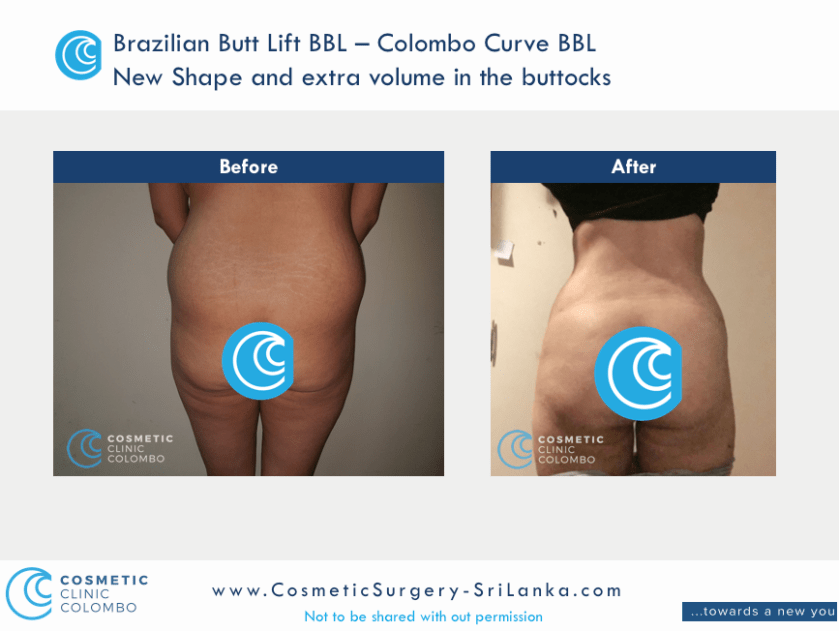 Brazilian Butt Lift Surgery BBL - Beautiful C shape buttocks - Cosmetic Surgery Sri Lanka