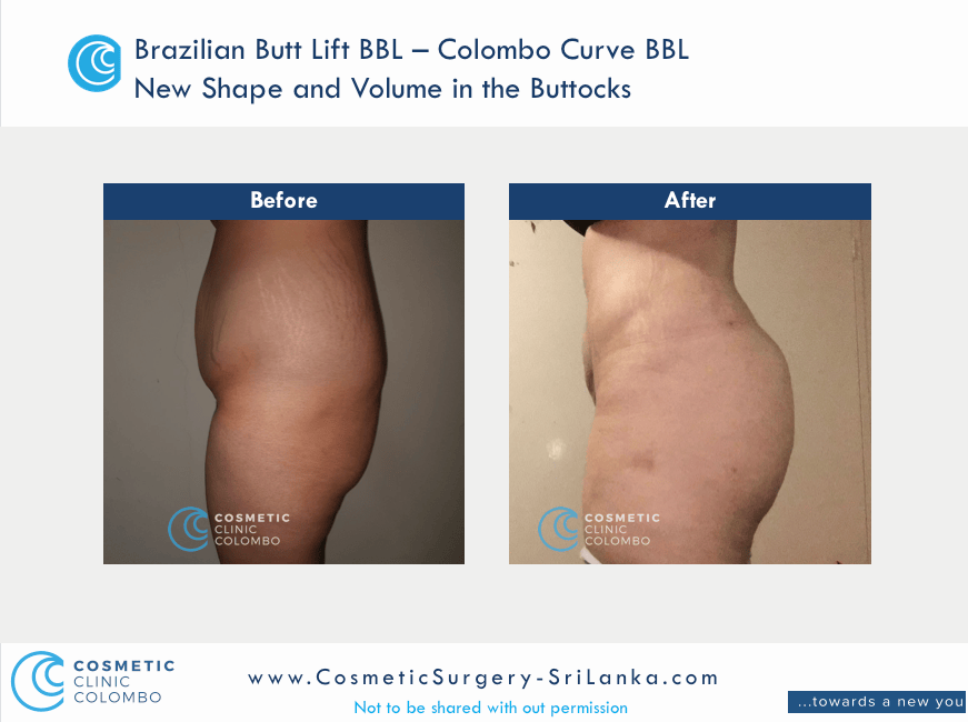 Brazilian Butt Lift Surgery BBL - Beautiful C shape buttocks - Cosmetic Surgery Sri Lanka