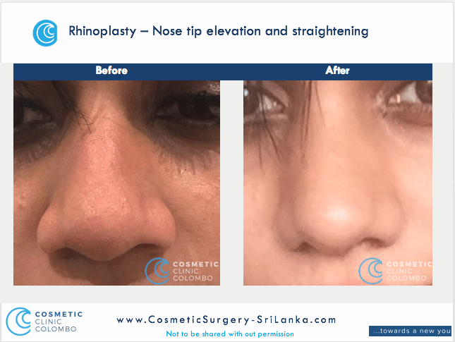 Nose surgery Sri Lanka