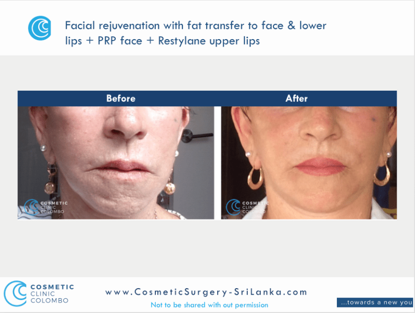 Lip Fillers Plump up Lips Colombo Sri Lanka