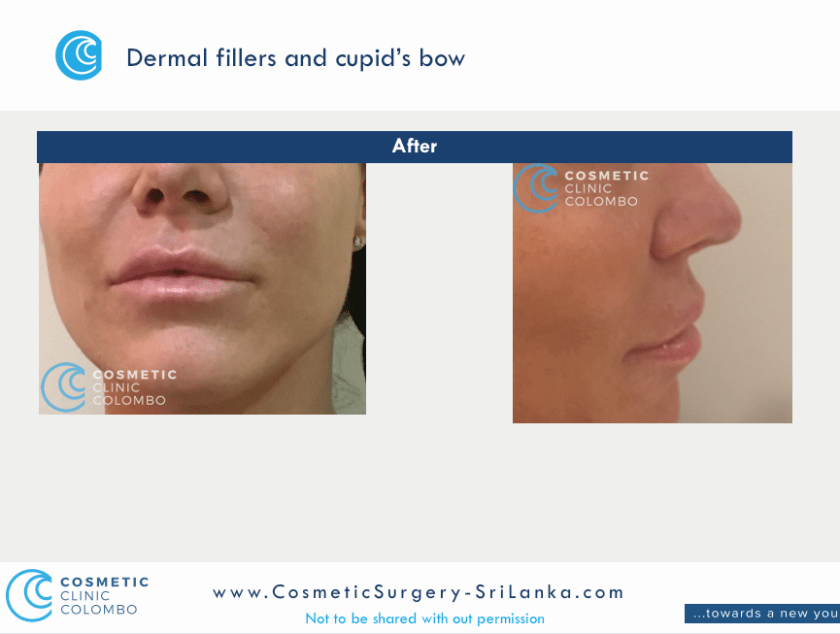 Lip Fillers Plump up Lips Colombo Sri Lanka